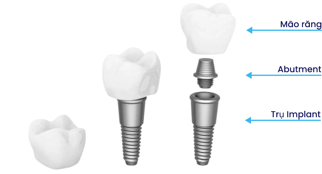 Cấu trúc răng implant